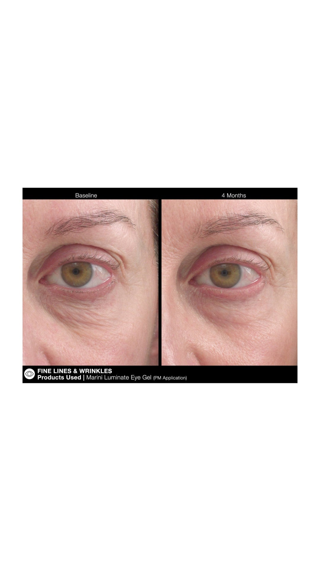 What Causes Dark Circles Around Eyes Nhs